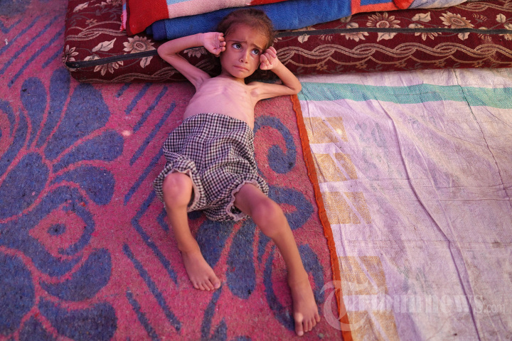 Anak Gaza Kekurangan Gizi di Tengah Serangan Israel