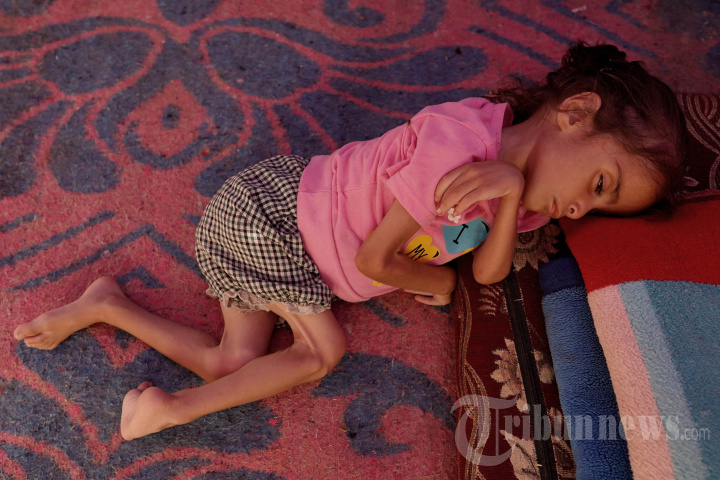 Anak Gaza Kekurangan Gizi di Tengah Serangan Israel