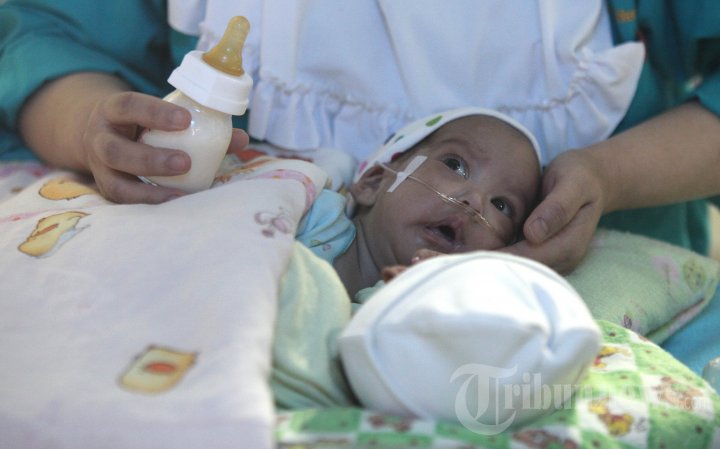 Bayi Kembar Siam Asal Ciamis Siap Dioperasi