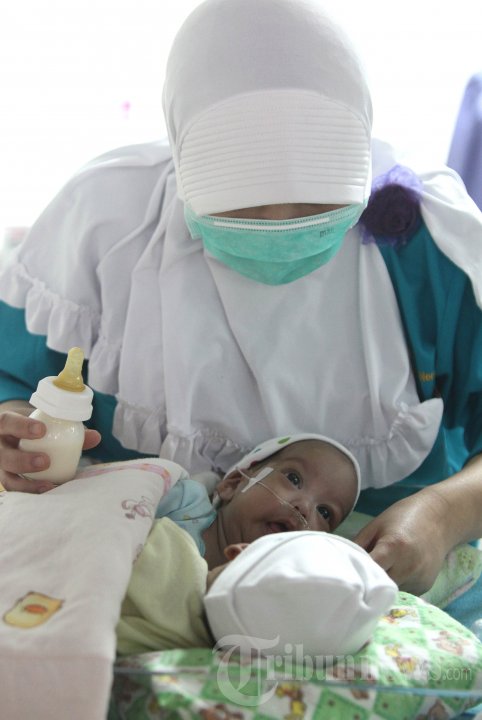 Bayi Kembar Siam Asal Ciamis Siap Dioperasi