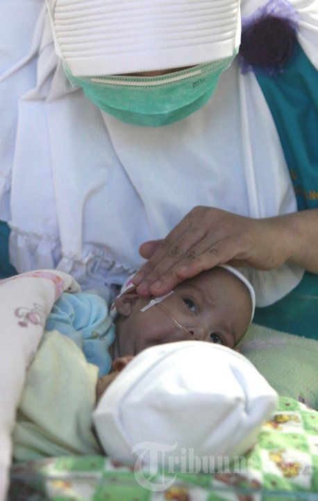 Bayi Kembar Siam Asal Ciamis Siap Dioperasi
