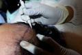 layanan-transplantasi-rambut_20220427_203639.jpg
