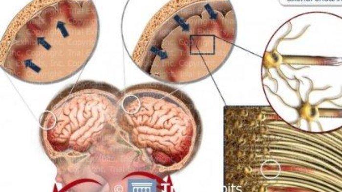 Ilustrasi Diffuse Axonal Injury.