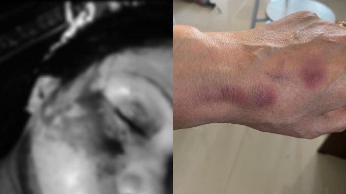 KDRT yang dilakukan oleh dosen UNS berinisial BW.