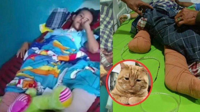 Kaki Nabila Febrianti (12), bocah SD asal Bilah Hilir, Kabupaten Labuhanbatu, Sumatra Utara, harus diamputasi karena terlindas truk setelah menyelamatkan kucingnya.