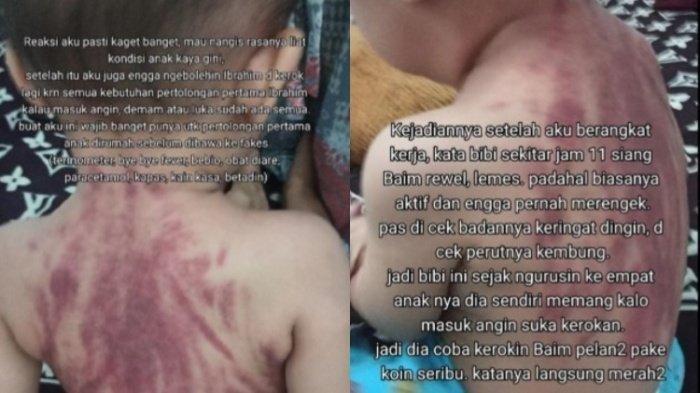 Seorang bayi berusia 13 tahun dikeroki hingga viral, begini penjelasan dari dokter