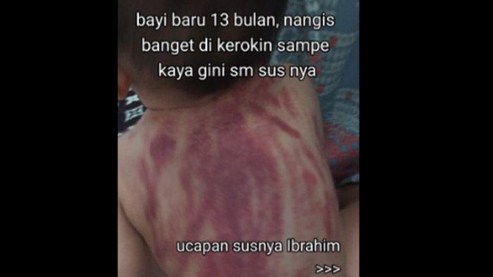 Tangkapan layar video yang memperlihatkan seorang bayi berusia 13 bulan dengan punggung bekas kerokan.