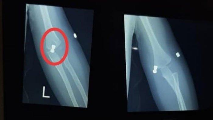 Hasil rontgen KH yang menjadi korban peluru nyasar, Rabu (5/8/2020).