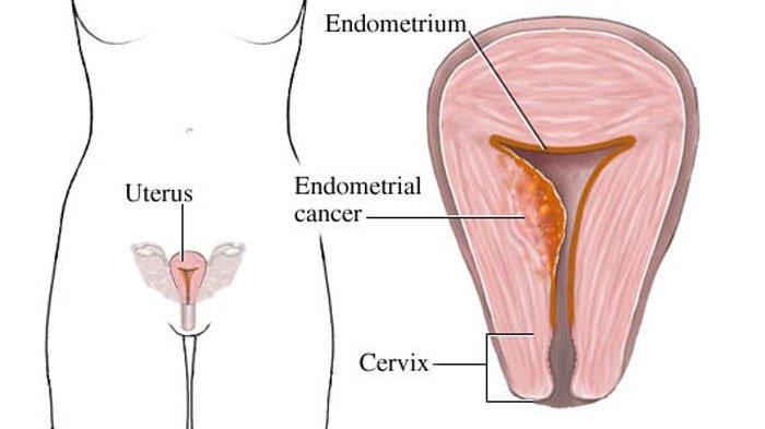 Kanker endometrium