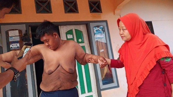 Kondisi Aria Permana (13) usai jalani operas