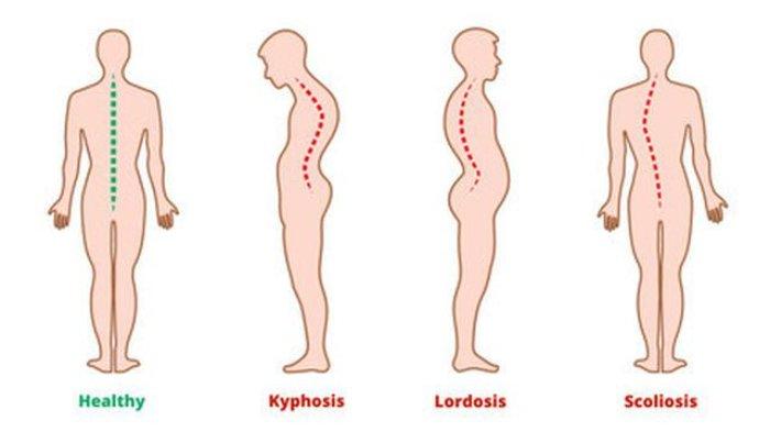 Lordosis