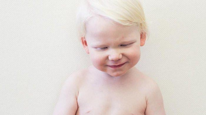 Perubahan atau disebut juga mutasi gen menjadi penyebab albinisme