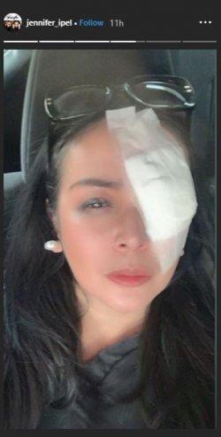 Tampak mata kiri Jennifer Jill diperban