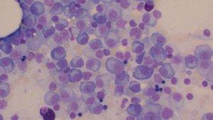 Multiple-Myeloma.jpg