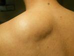 1-Lipoma.jpg