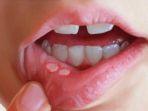 2-Stomatitis-Aphtosa-Sariawan.jpg