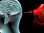 Aneurisma-Otak.jpg