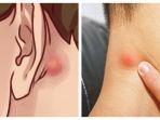 Benjolan-pada-Telinga.jpg