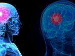 Ilustrasi-kanker-otak.jpg
