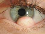 Limbal-Dermoid.jpg