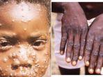 Mengenal MPOX, Penyakit Cacar Monyet yang Saat Ini Kembali Viral, Ada 88 Kasus di Indonesia