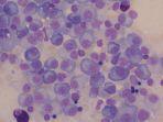 Multiple-Myeloma.jpg