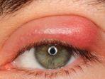 blefaritis.jpg