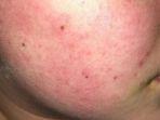 cholinergic-urticaria.jpg