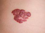 hemangioma.jpg