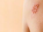 herpes-zoster-atau-cacar-api-adalah-infeksi-pada-saraf-dan-kulit-di-sekitarnya.jpg