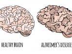 ilustrasi-alzheimerrr.jpg