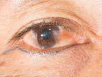 ilustrasi-penderta-penyakit-mata-pinguecula.jpg