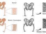 ilustrasi-penyakit-osteomalasia.jpg