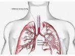 ilustrasi-pneumonia-2.jpg