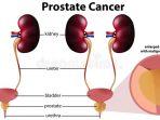 kanker-kelenjar-prostat.jpg