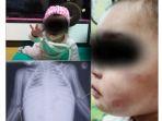 keadaan-bayi-jung-in-yang-patah-tulang-dan-tubuh-penuh-luka.jpg