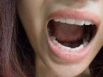 oral-thrush-3.jpg