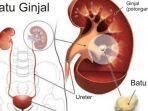 penyakit-batu-ginjal.jpg