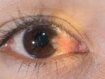 penyakit-mata-pterigium.jpg