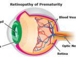 retinopati-prematuritas.jpg