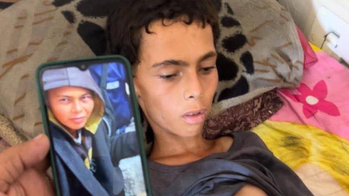 MALNUTRISI GAZA-Viral foto-foto seorang remaja di Palestina yang mengalami malnutrisi hingga menyisakan berat hanya 25 kg pada Sabtu (2/8/2025).