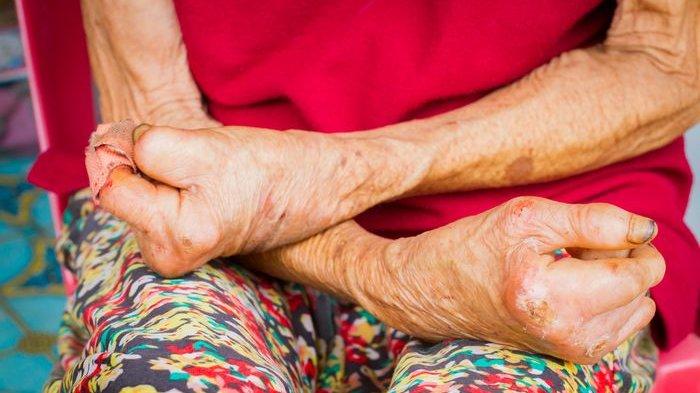 Diskriminasi dan Stigma Negatif Bisa Membuat Penyintas Kusta Alami Tekanan Psikologis