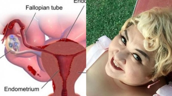 Selain Pembengkakan Hati, Pretty Asmara Pernah Alami Siklus Haid Panjang Begini Cirinya