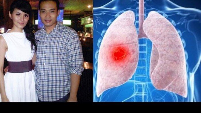 Suami Intan RJ Meninggal karena Infeksi Paru-paru, Sekilas Gejalanya Mirip COVID-19