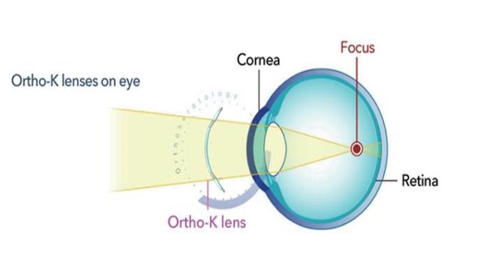 Cara-kerja-lensa-Orthokeratology-atau-lensa-Ortho-K.jpg