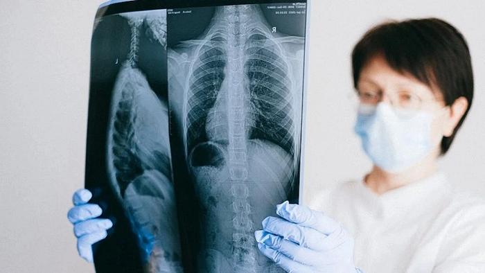 Mengenal VATS, Teknologi Bedah Minimal Invasif Menggunakan Video Kamera untuk Pasien Kanker Paru