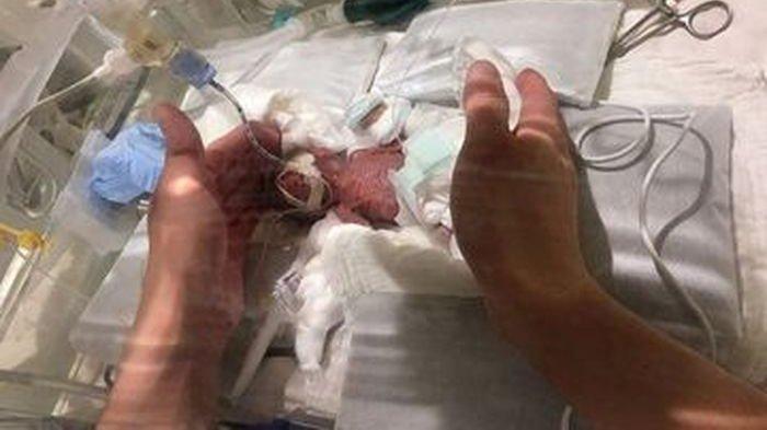 Bayi Paling Mungil di Dunia Hanya Sebesar Dua Telapak Tangan Orang Dewasa