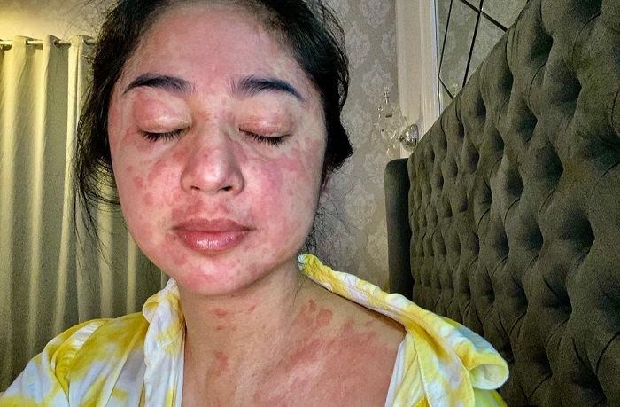 Sempat Alami Kondisi Aneh pada Kulitnya, Dewi Perssik Bersyukur Kini Sembuh dari Covid-19