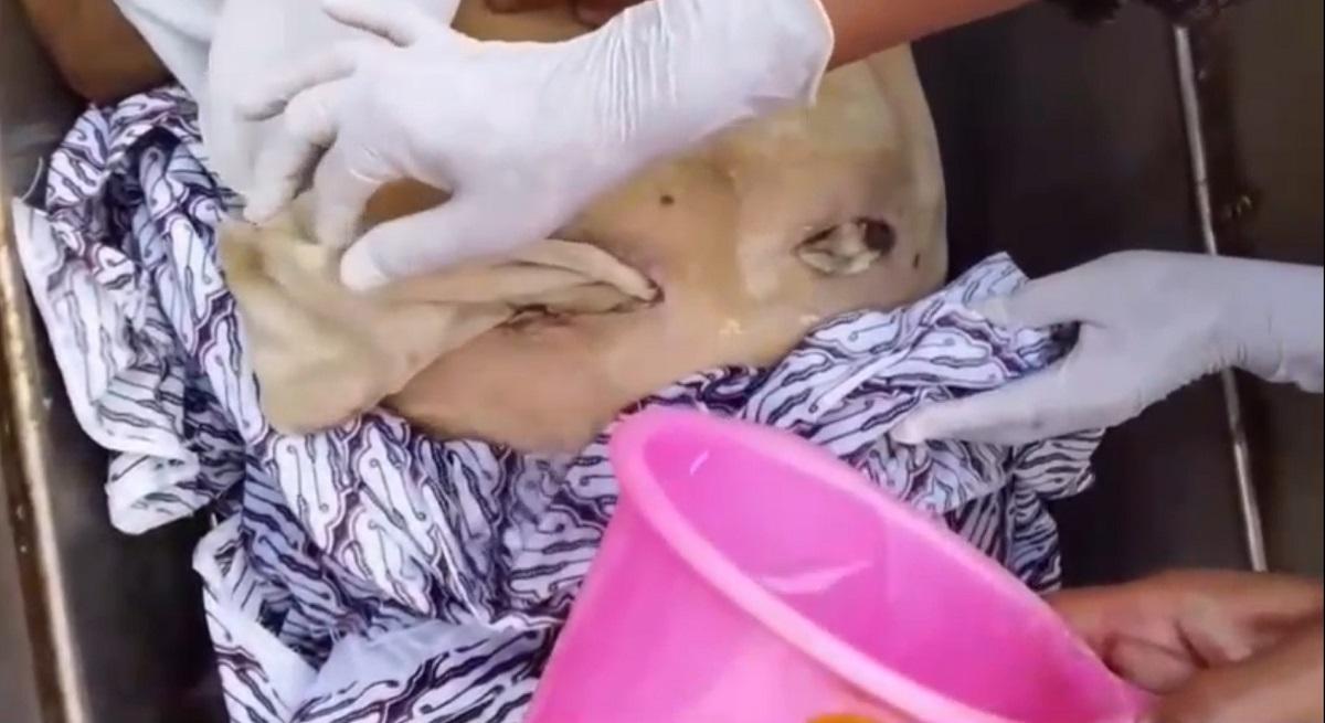 Keluarga Kaget, Luka Operasi Wanita di RS Hastien Karawang Tidak Dijahit
