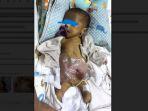Nala-bayi-2-bulan-berjuang-menghadapi-fase-kritisnya-di-NICU-RSAB-Harapan-Kita.jpg
